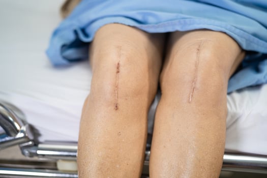 senior ady woman patient show her scars surgical total knee joint replacement Suture wound surgery arthroplasty on bed in nursing hospital ward, healthy strong medical concept. photo