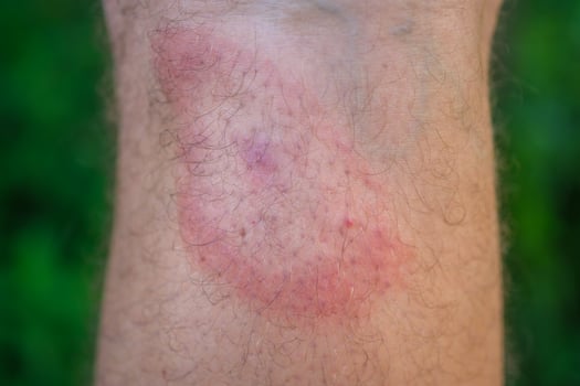 migrating erythema after a tick bite on a man's leg photo