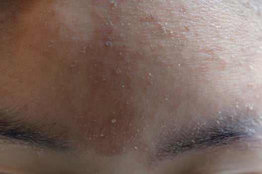 woman with symptom of atopic dermatitis on Forehead. photo
