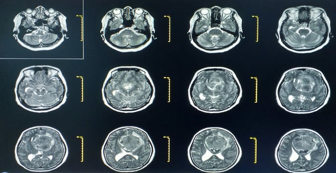MRI BRAIN Finding of meningioma photo