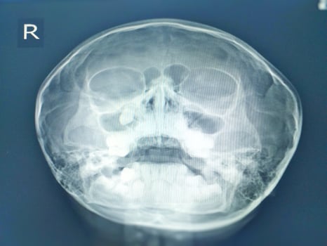 Paranasal sinuses x-ray finding Tooth in right maxillary sinus.No sinusitis. No bony destruction or mass. photo