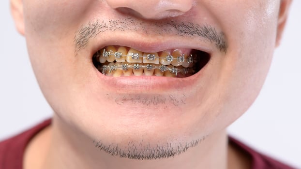 Close up of Man's mouth with braces , yellow plaque teeth  because drinking coffee regularly photo