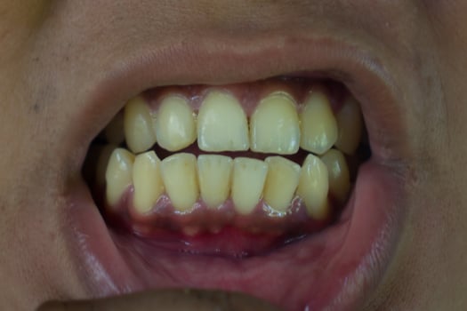 a man's teeth are yellow photo