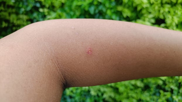 Small wound bleed on a man's arm. photo