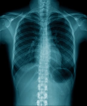 chest x-ray show inside of lung photo