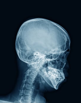 x-ray human skull in blue photo