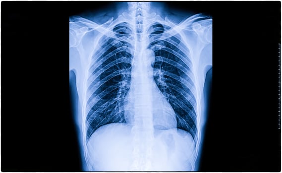 Heart Failure, Film X-Ray Chest Pa Upright Show Cardiomegaly And Interstitial Infiltrate Both photo