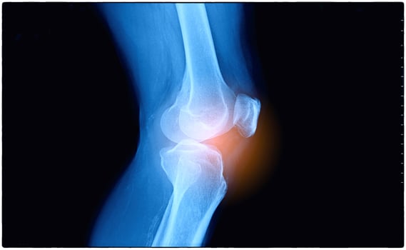 Film x-ray human's knee joints photo