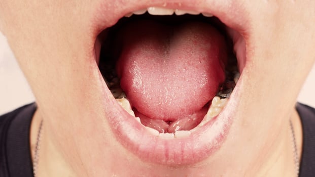 Decayed tooth root canal treatment. Tooth or teeth decay of lower molar. photo