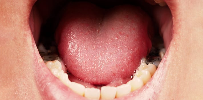 Decayed tooth root canal treatment. Tooth or teeth decay of lower molar. photo