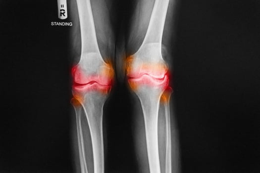 Osteoarthritis Right knee film x-ray AP anterior - posterior of knee show narrow joint space . photo