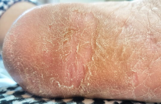 Cracked foot palm and heel. Winter drying. photo