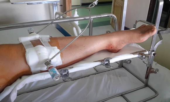 foot splint with iron on leg photo