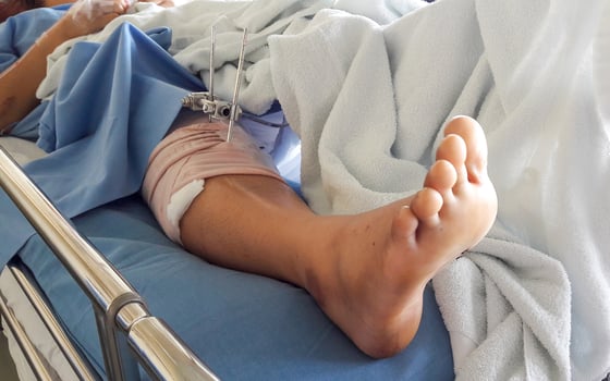 foot splint with iron on leg photo
