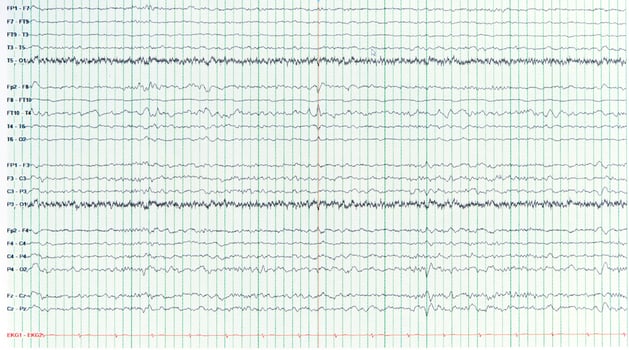Photography of sharp wave during interictal EEG in epilepsy photo