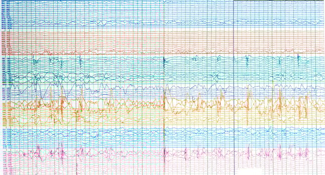 Photography of brain waves  of epileptic patient showing sharp wave during  no seizure or interictal EEG. photo