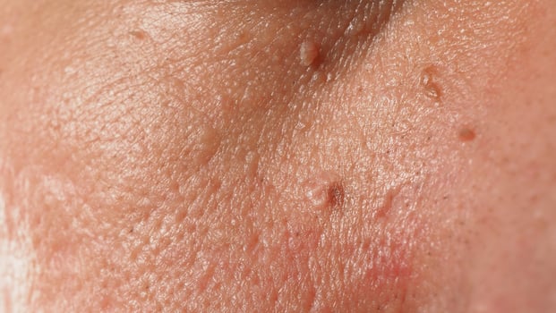 Wart skin removal. Macro shot of warts near eye on face. photo