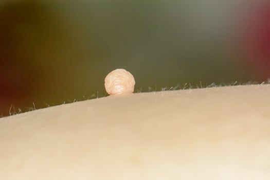 Skin tag or acrochondon or soft fibroma photo