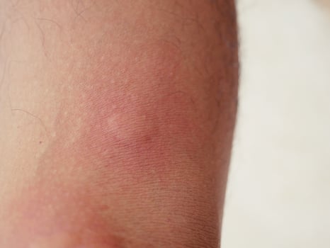 A bruise that has been stung by an insect. photo