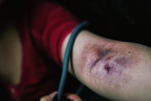 Adult girl with dreadlocks before taking dose of narcotic into vein. photo