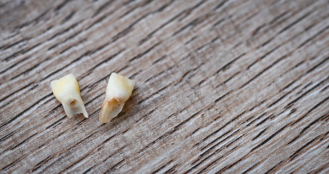 Milk tooth , Close up baby teeth of tooth loss on wooden , milk tooth dental health problems concept photo