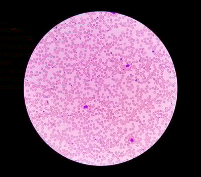Photomicrograph or microscopic image showing Hemoglobin D trait with iron deficiency anemia. photo