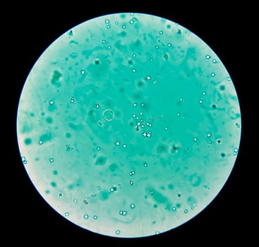 Calcium oxalate crystal from urine sediment. photo