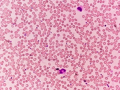 Photomicrograph or microscopic image showing Hemoglobin D trait with iron deficiency anemia. photo