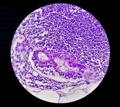 Photomicrograph or microscopic image of Stomach cancer. Adenocarcinoma of stomach photo