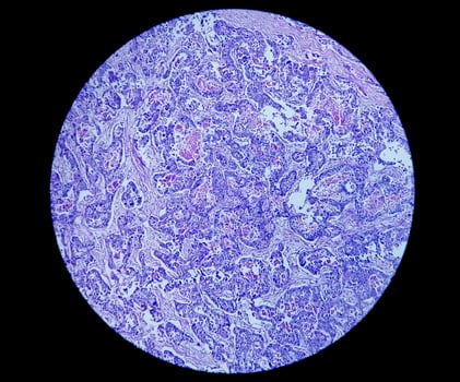 Photomicrograph or microscopic image of Stomach cancer. Adenocarcinoma of stomach photo