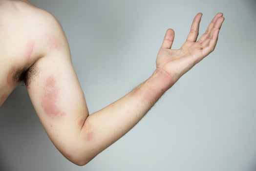 Man getting red skin rash at his body part - people with skin allergy problem concept photo