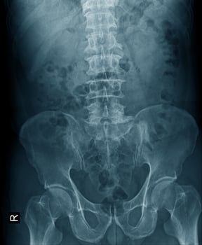 x-ray image of lumbo sacral photo