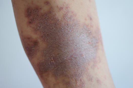 red rash girl Skin disease caused by allergies to drugs, food, chemicals, poor immune system in the lymph. photo