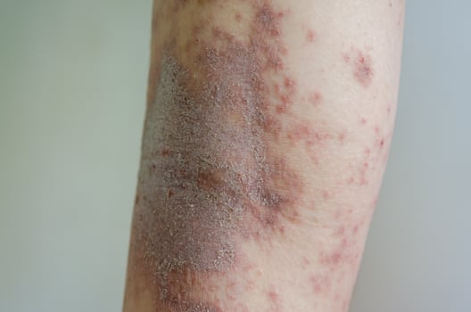 red rash girl Skin disease caused by allergies to drugs, food, chemicals, poor immune system in the lymph. photo
