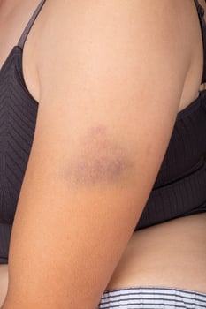 hematoma on the female, bruise on woman arm photo