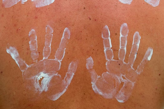 white hands sun protector cream shape on skin photo