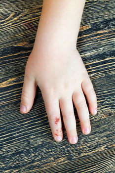 damaged one finger photo