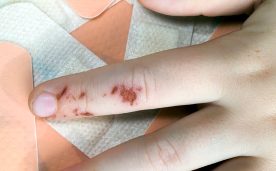 damaged one finger photo