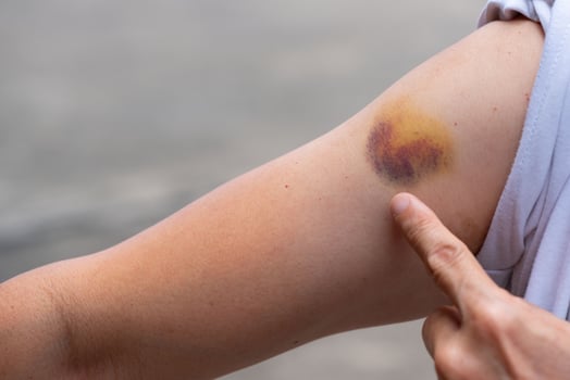 Bruise on a woman right arm photo