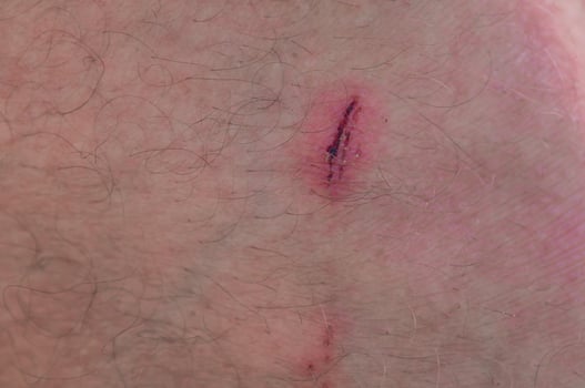 scratch on man's leg. wound on the skin. photo