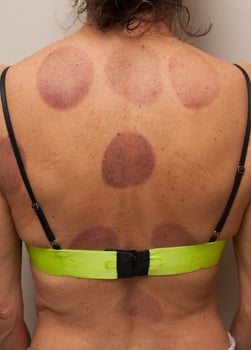 A woman that had Cupping Therapy done on her back for pain photo