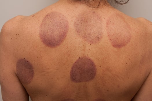 A woman that had Cupping Therapy done on her back for pain photo
