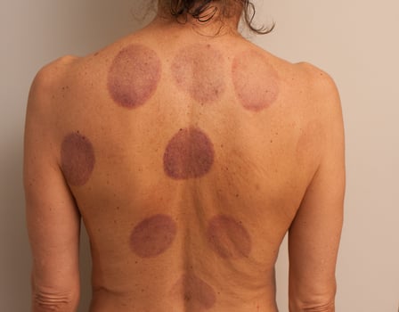 A woman that had Cupping Therapy done on her back for pain photo