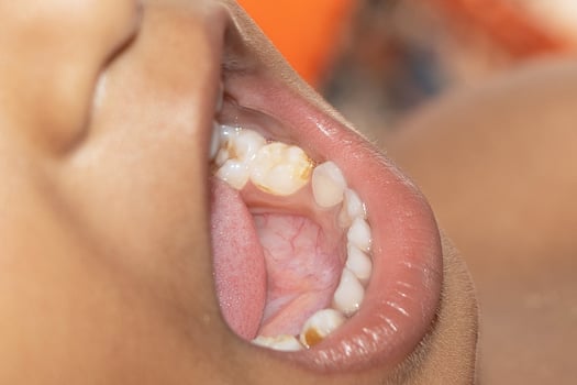baby smile close. white teeth of a child isolated photo