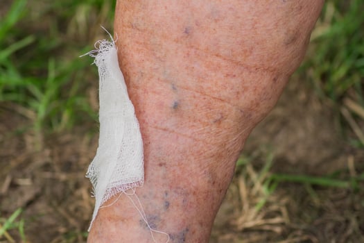 injured leg of elderly woman ith varicose veins. bandage on the wound photo