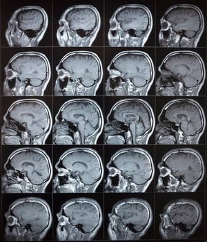 Side view of human normal brain MRI photo
