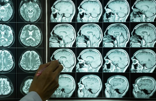 A hand pointing at brain MRI images photo