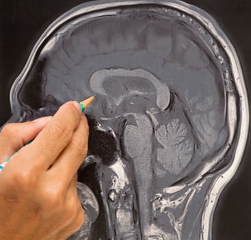 MRI brain picture and doctor's hand photo