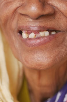close up of senior women's dental caries and some broken teeth photo