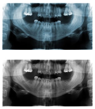 Panoramic dental X-Ray images photo